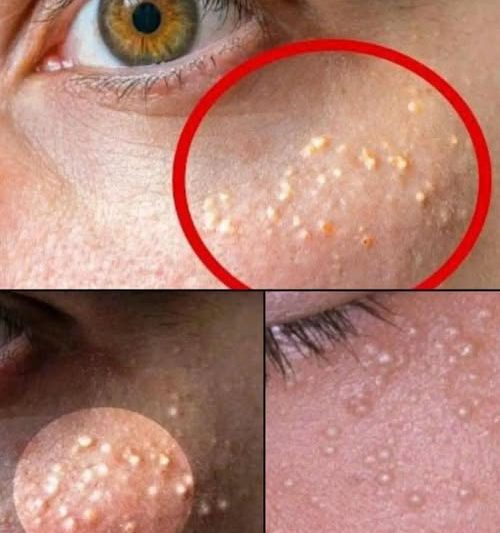 Tiny White Bumps on Your Face? Here’s What They Are—And How to Treat Milia Naturally and Safely at Home