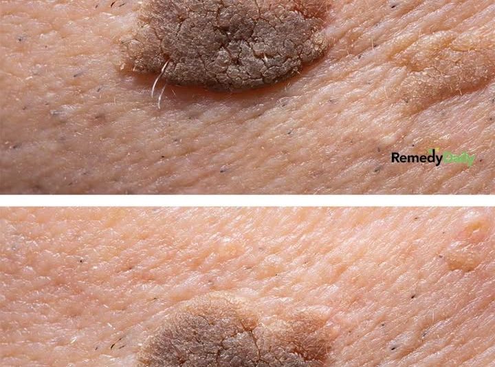 This mole-like spot is growing but doesn’t hurt. Doctor appt is far away. What should I do? – Daily Spire