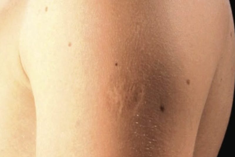Smallpox vaccine scars: What they look like and why – Daily Spire